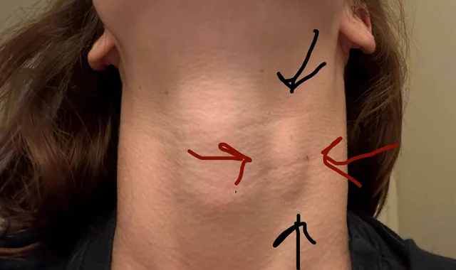 painful-lump