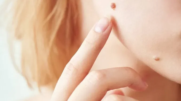 ABCDE rule actinic keratosis basal cell carcinoma dermatologist check early detection skin cancer melanoma symptoms mole changes skin skin cancer skin cancer prevention skin cancer warning signs squamous cell carcinoma suspicious moles 