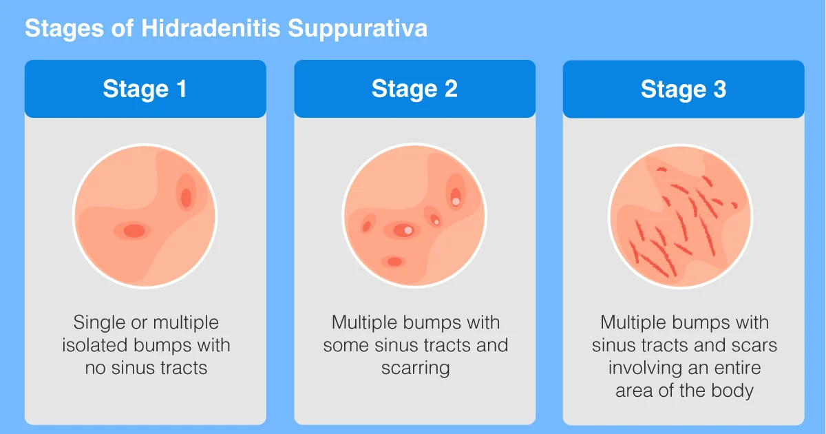 Stages of Hidradenitis Suppurativa