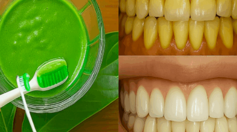 cloves for oral health dental care tips guava leaves antibacterial benefits Herbal Medicine Holistic Health natural remedies 