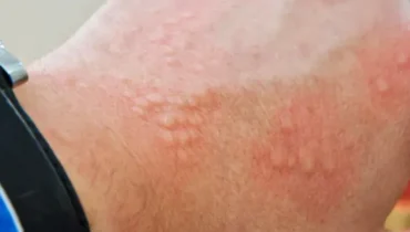 This skin condition affects 90% of men but they’re too embarrassed to talk about it This skin condition affects 90% of men but they’re too embarrassed to talk about it