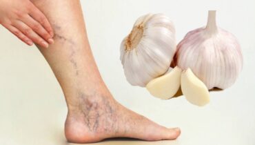 boost vein health naturally garlic for varicose veins garlic lemon drink benefits garlic olive oil salve home remedies for varicose veins improve circulation naturally natural varicose vein remedies 