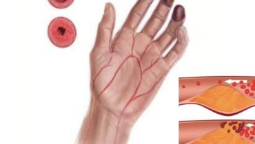 Ayurveda beetroot blood sugar blood circulation bone and joint health prevention Herbal Medicine natural remedies Neem Leaves 