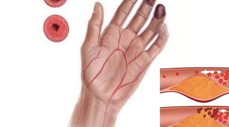 Ayurveda beetroot blood sugar blood circulation bone and joint health prevention Herbal Medicine natural remedies Neem Leaves 