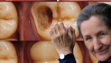 Cavity Prevention Diet Changes herbal oral hygiene Mineral-Rich Foods natural health tonic Tooth Enamel 