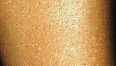 After 40, these white spots appear on your arms… here’s what they really mean After 40, these white spots appear on your arms… here’s what they really mean