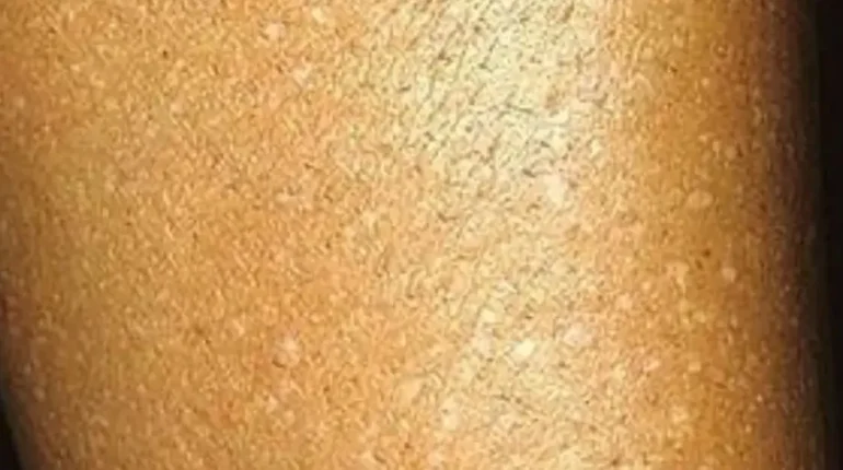 Aging Skin Dermatology melanoma signs Skin Health Skin Spots sun exposure 