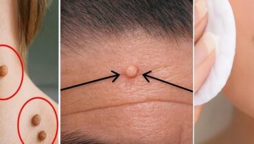 baking soda skincare coffee and vaseline for heels Dermatology garlic home remedies natural beauty hacks natural remedies Skin Tags 