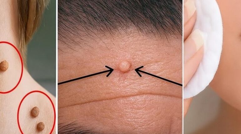 baking soda skincare coffee and vaseline for heels Dermatology garlic home remedies natural beauty hacks natural remedies Skin Tags 