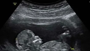 autism research gut microbiome immune system and brain Maternal Health neurodevelopment 