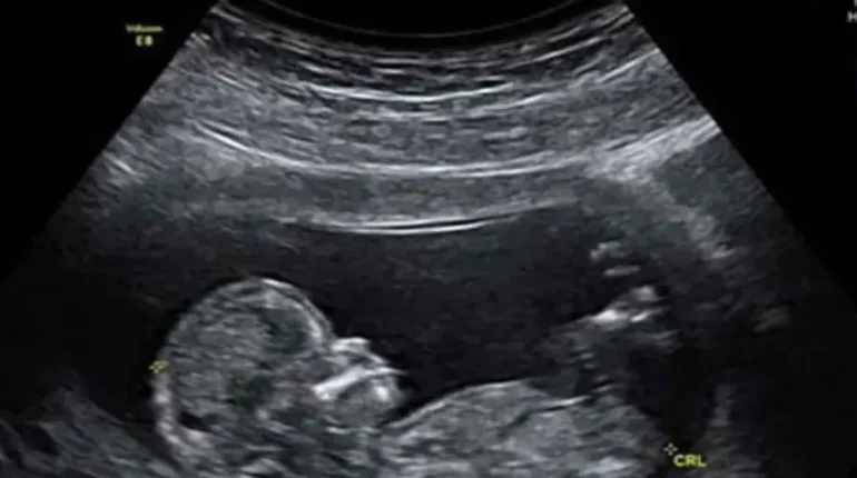 autism research gut microbiome immune system and brain Maternal Health neurodevelopment 