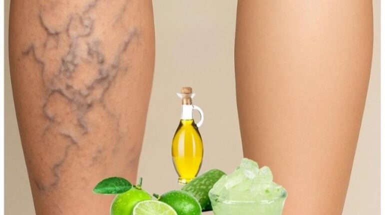 aloe vera and amla oil baking soda skincare garlic for varicose veins garlic home remedies morning bruises on legs natural remedies Tired Legs 