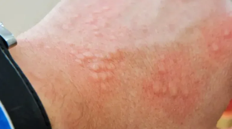 The hidden reason your skin keeps burning down there