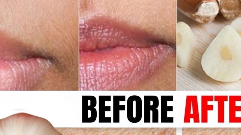 antifungal properties of garlic Dermatology garlic home remedies Kalanchoe skin care natural treatments Skin Tags 