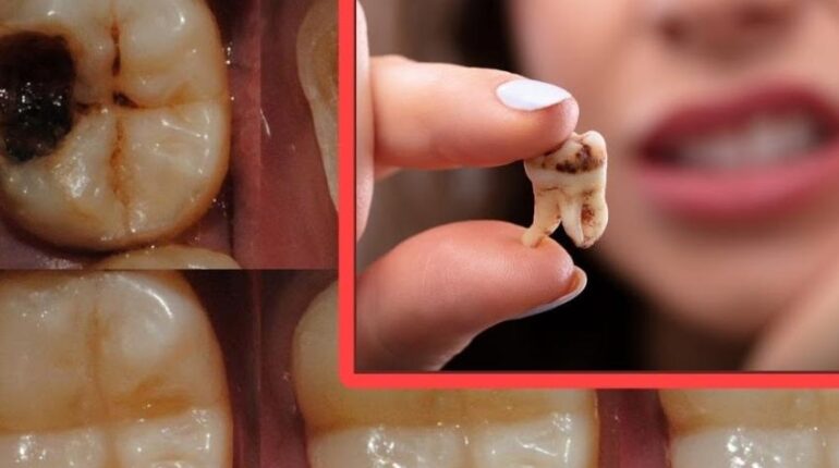 Cavity Prevention cloves for oral health dental care tips Healthy Habits natural remedies Oil Pulling Tooth Health 