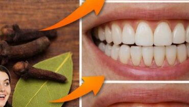 Tartar Removal and Teeth Whitening: How Daily Habits and Professional Care Prevent Gum Disease Naturally Tartar Removal and Teeth Whitening: How Daily Habits and Professional Care Prevent Gum Disease Naturally