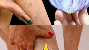 Varicose Veins: How Red Onion, Garlic, and Apple Cider Vinegar Support Circulation Through Simple Home Treatments