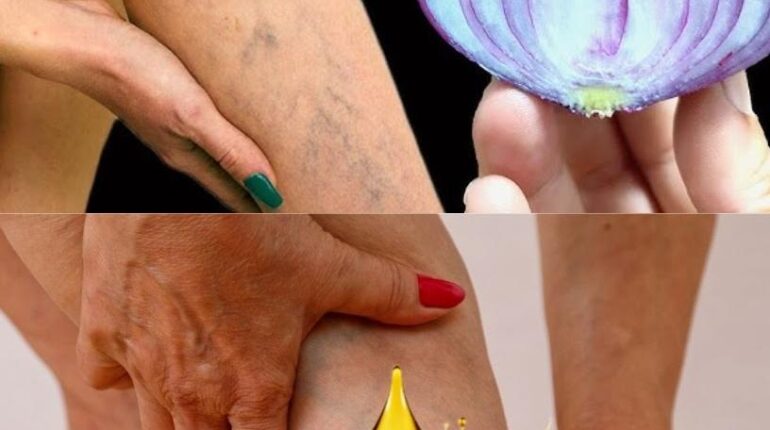 blood circulation colon health tips garlic for varicose veins garlic home remedies Herbal Remedies natural treatments 