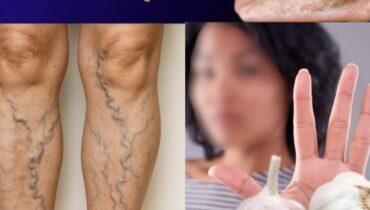 At 47, She Does This With Garlic & Cloves 3 Times a Week for Her Legs At 47, She Does This With Garlic & Cloves 3 Times a Week for Her Legs