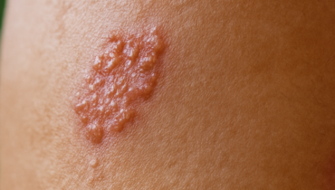 Antiviral Treatment Herpes Zoster history of smallpox vaccination Nerve Damage Shingles Varicella Virus 