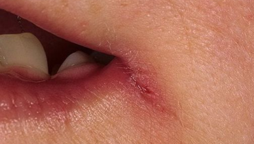 Nutritional Deficiencies: 5 Body Symptoms That Reveal What Your Diet Is Missing