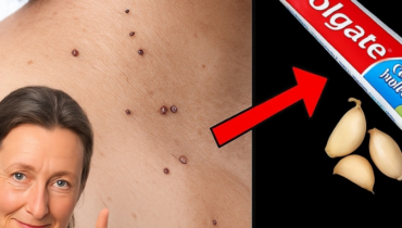 Skin Tags and Warts: How Vinegar, Baking Soda, and Tea Tree Oil Create a Natural Removal Treatment Skin Tags and Warts: How Vinegar, Baking Soda, and Tea Tree Oil Create a Natural Removal Treatment