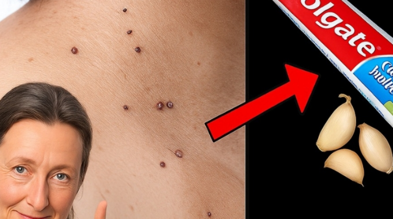 apple cider vinegar elixir Baking Soda garlic home remedies natural remedies Skin Tags Tea Tree Oil Warts 