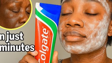 Acne treatment baking soda skincare Beauty Tips garlic home remedies natural skincare treatment Skin Health 