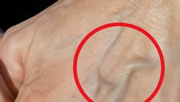 Acne-prone skin Advocate Health blood circulation blue veins deep vein thrombosis Medical Conditions non-alcoholic fatty liver disease 