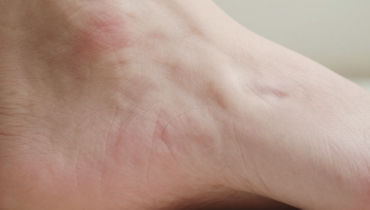 Dry and painful heels: 5 effective natural remedies using everyday ingredients Dry and painful heels: 5 effective natural remedies using everyday ingredients