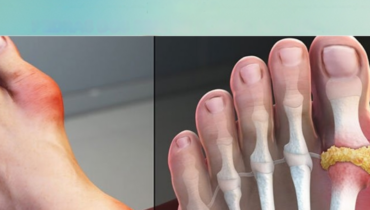 Alfalfa avoid extreme detox goosegrass kidney support Herbal Remedies natural health tonic Uric Acid Urinary Health 