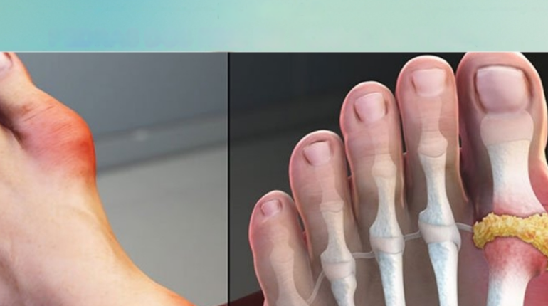 Alfalfa avoid extreme detox goosegrass kidney support Herbal Remedies natural health tonic Uric Acid Urinary Health 