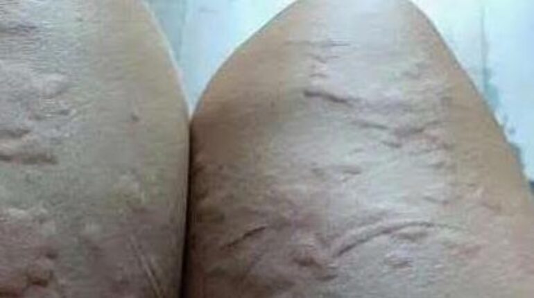 Dermatology Genital Health medical advice Skin Conditions STIs 