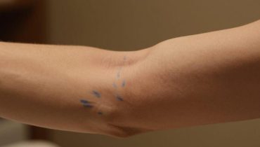 Visible veins in the evening: thermal vasodilation and 6 other physiological causes explained