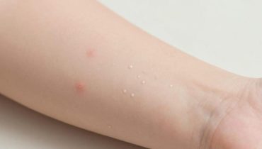 Molluscum contagiosum: these small pearly bumps on children’s skin disappear on their own in 6 to 12 months