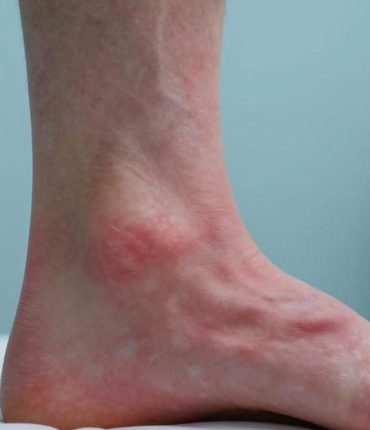 Swollen feet: 8 serious diseases that this symptom can reveal (heart, kidneys, liver)