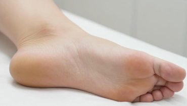 Plantar warts: 5 validated natural remedies to eliminate them without surgery or chemicals