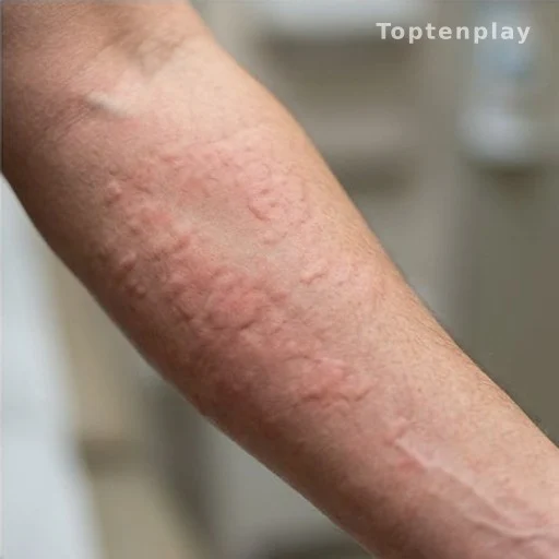Hives and Anaphylaxis: When a Skin Reaction Becomes an Emergency