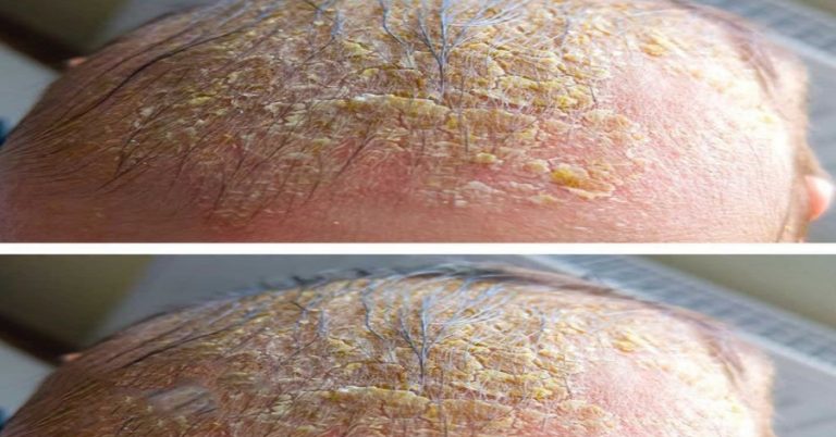 oozing-yellow-crust-on-your-scalp-causes-treatment cover