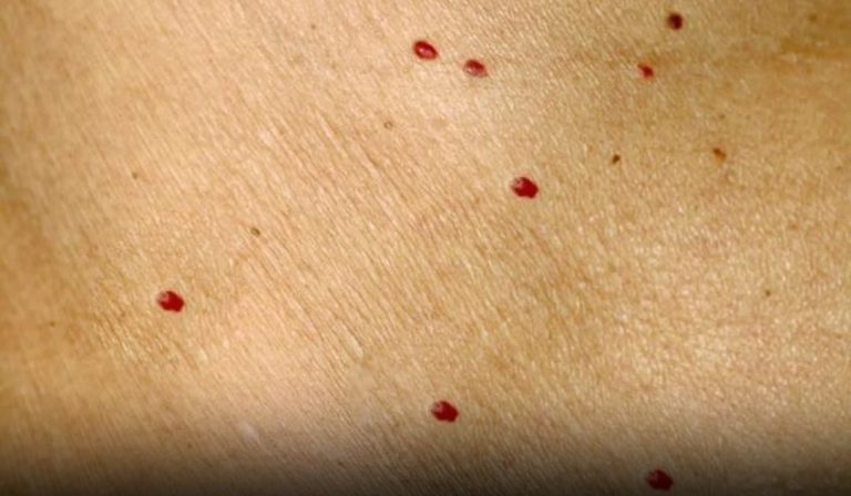 red-dots-on-your-skin-11-causes-from-harmless-to-s cover