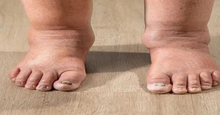 swollen-ankles-at-night-when-to-worry-and-what-to- cover