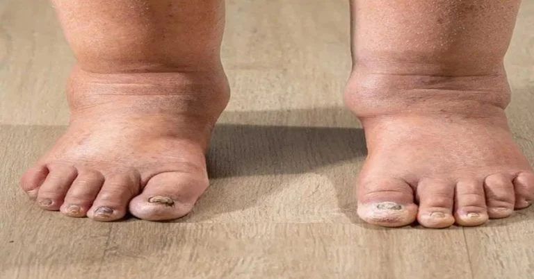 swollen-ankles-at-night-when-to-worry-and-what-to- cover