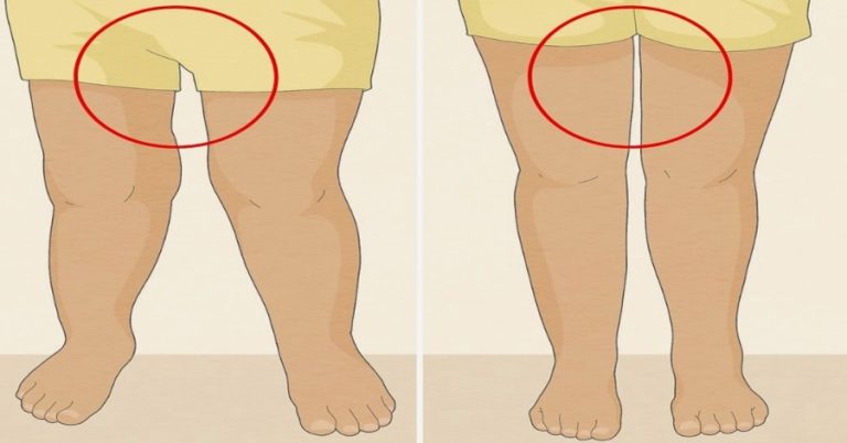the-thigh-gap-myth-why-genetics-not-diet-decides-i cover