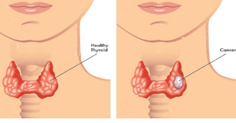 thyroid-cancer-is-rising-the-10-foods-doctors-say- cover