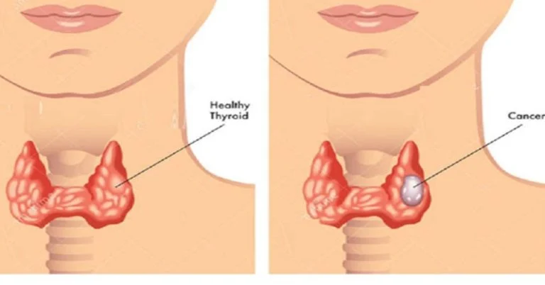thyroid-cancer-is-rising-the-10-foods-doctors-say- cover