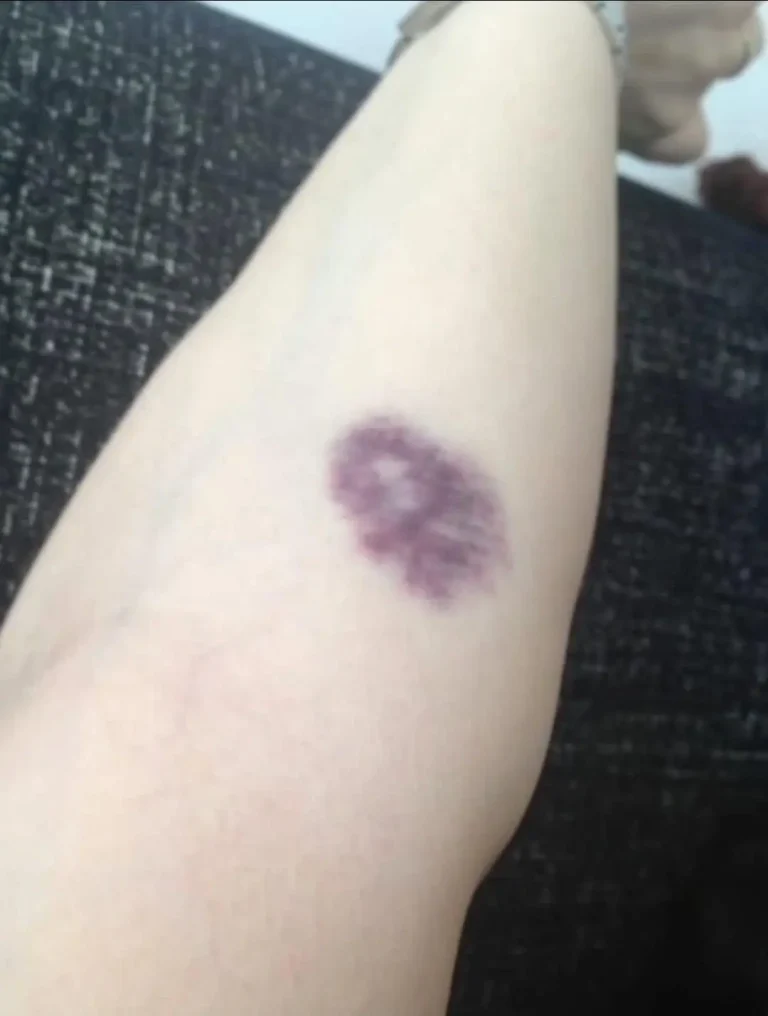 unexplained-bruises-the-warning-signs-you-should-n cover