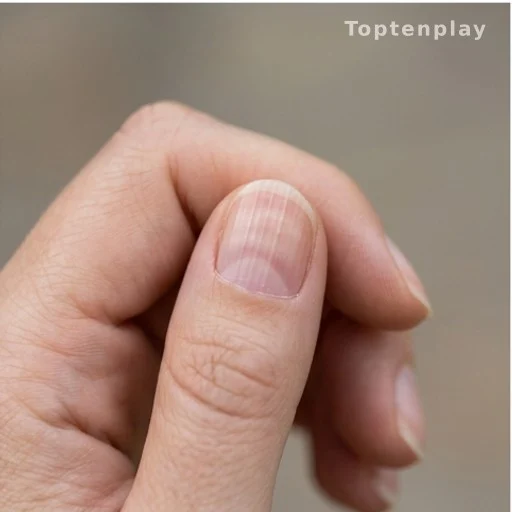 Close-up of fingernails showing vertical ridges, a common sign of aging or thyroid health changes